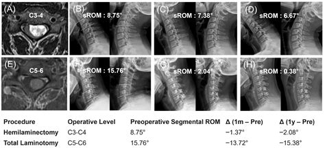 Sagittal Alignment and Segmental Mobility After Cervical Intradural ...