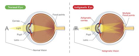 I have astigmatism, so does that mean I'm not suitable for laser eye surgery? | Vision Surgery