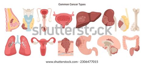 Types of Cancer Names 的图像结果