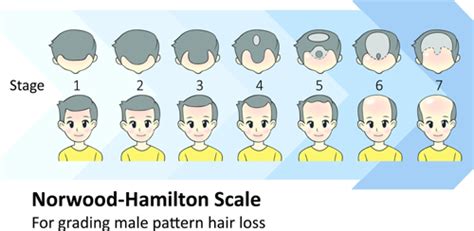 क्या है Norwood Scale, जिसे गंजापन मापने के लिए इस्तेमाल किया जाता है ...