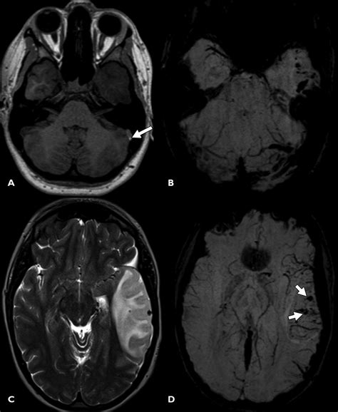 Susceptibility-Weighted Imaging of the Pediatric Brain | AJR