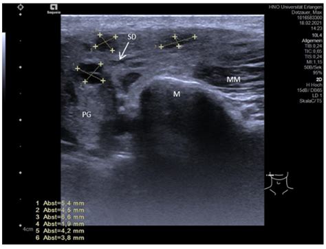 Parotid Gland Tumor Ultrasound