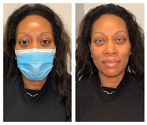 Image result for Eye Color Surgery