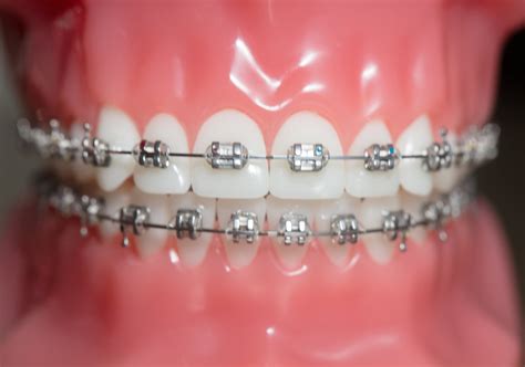 Traditional Metal Braces