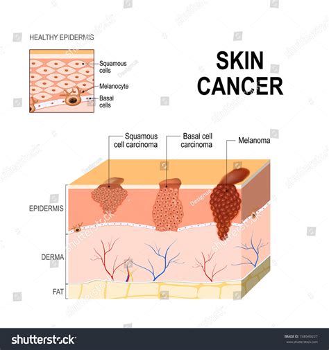 Skin Cancer Squamous Cell Carcinoma Basal-cell Stock Vector (Royalty Free) 748949227 | Shutterstock