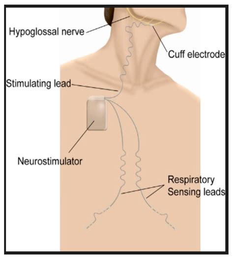 Hypoglossal Nerve Stimulator