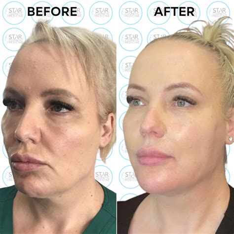 Image result for Thread Removal