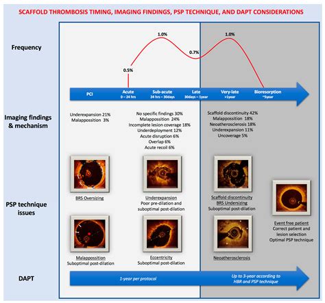 Impact of PSP Technique on Clinical Outcomes Following Bioresorbable ...
