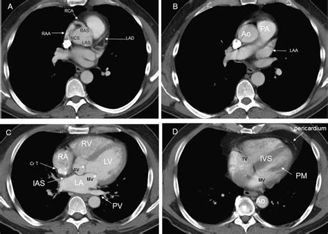 Cardiac findings on non-gated chest computed tomography: A clinical and pictorial review ...