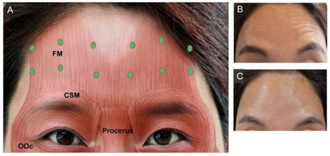 Image result for Botox Forehead Injection Sites Tutorial
