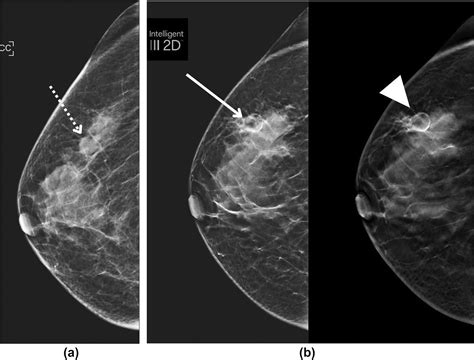 Fat necrosis in the breast: a multimodality imaging review of its ...