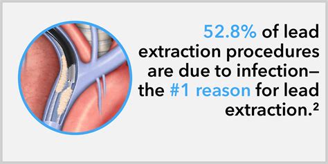 Image result for Laser Lead Extraction Animation Spectranetics