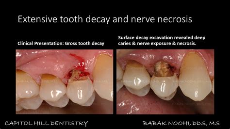 Decayed Tooth Pulling 的图像结果