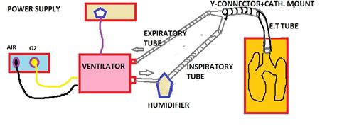 Ventilator Tutorial 的图像结果