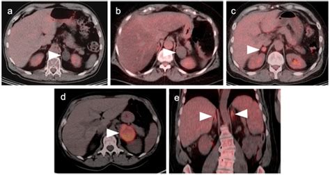 PET-CT in Clinical Adult Oncology: III. Gastrointestinal Malignancies
