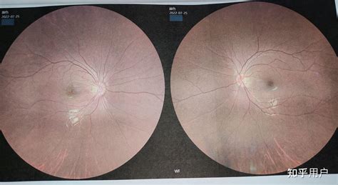 近视激光手术会导致眼睛受损吗？会致盲吗？