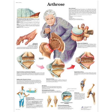 Arthrose | 1001308 | 3B Scientific | VR0123L | Arthritis Patient Education - Arthritis Models ...