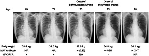 Adult acetonemic vomiting complicated with low body weight in a subject ...