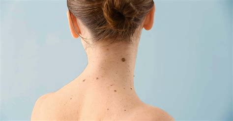 Causes of Skin Tags on Neck (Why and How) DIY? – Skintify
