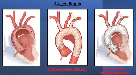 First-in-Human Endovascular Aortic Root Repair (Endo-Bentall) for Acute ...