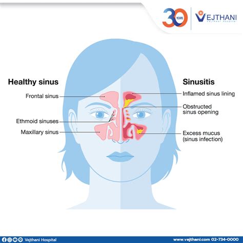 Chronic Sinusitis - Vejthani International Hospital | JCI Accredited ...