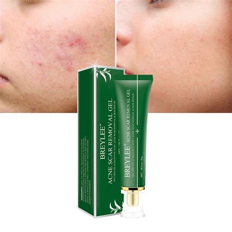 BREYLEE Scar Removal Gel Facial Anti Acne Pimple Removal Repair Sooth Essential Oil Whitening ...