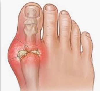 6 HOME REMEDY FOR GOUT - Health GadgetsNG