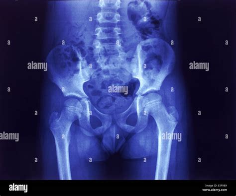 Young Female Pelvis X Ray Normal