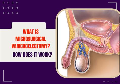 Varicocele Before And After Surgery