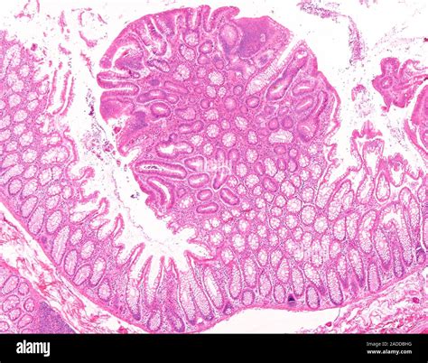 Tubular colon polyp, light micrograph. This specimen shows tissue from a tubular adenoma ...