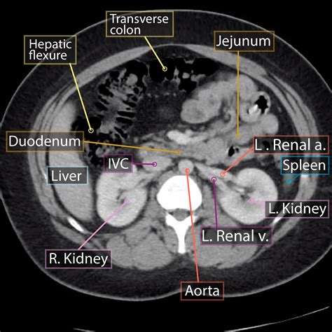 Gross Anatomy Glossary: Axial Abdominal CT | ditki medical & biological ...