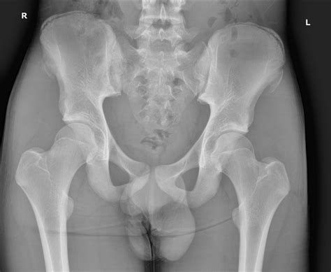 OrthoDx: ASIS Avulsion Fracture - Clinical Advisor