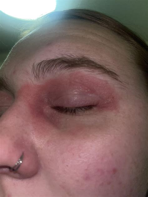 Eyelid Psoriasis : r/Psoriasis