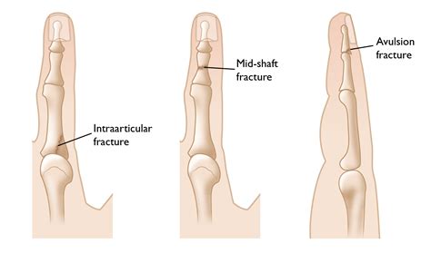 Finger Fractures - OrthoInfo - AAOS