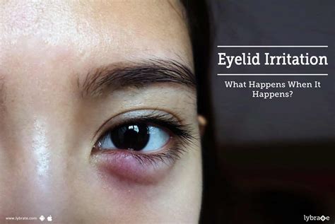 Eyelid Irritation - What Happens When It Happens? - By Asg Eye Hospital ...
