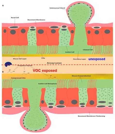 Pediatric Asthma Attack and Home Paint Exposure