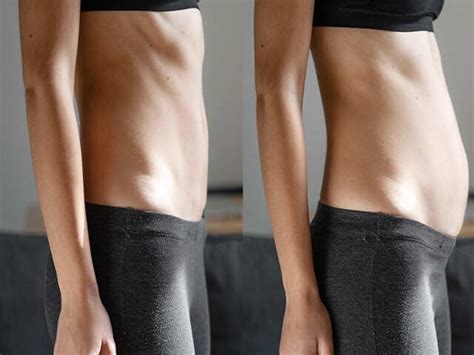 Understanding Diastasis Recti Abdominis, A Common Postpartum Injury ...
