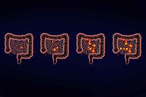 Small Intestine Cancer Stages: What to Expect - Apollo Proton