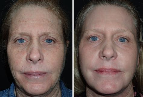 Co2 Fraxel Laser Before And After Fully Ablative CO2 Laser Resurfacing