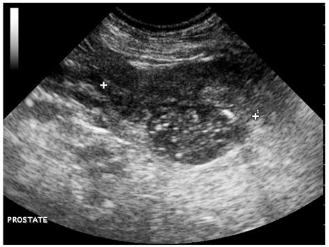 Hypertrophic Osteopathy Associated with a Prostatic Adenocarcinoma in a Castrated Dog