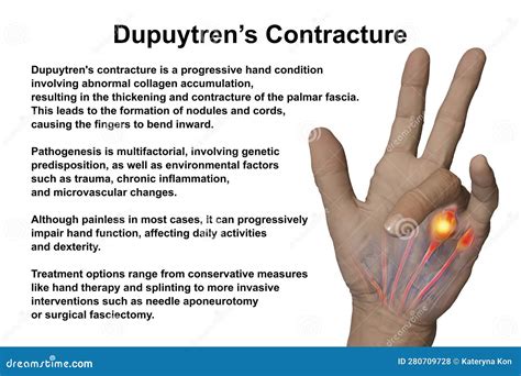 A 3D Medical Illustration Displaying a Patient S Hand with Dupuytren S ...