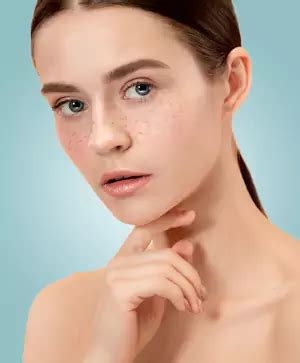 #1 Clinic for Melasma Treatment in Delhi