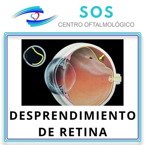 Tratamiento Quirúrgico para el Desprendimiento de Retina – Centro Oftalmológico SOS