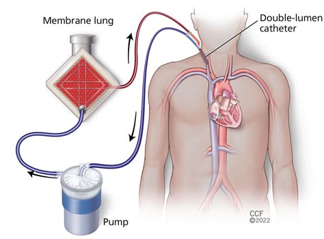 On the horizon: Extracorporeal carbon dioxide removal | Cleveland ...