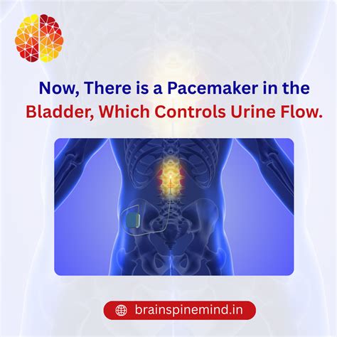 Bladder Pacemaker Treatment by Dr. Vaibhav Mathur | Urine Flow Control