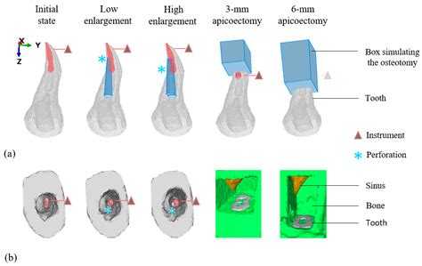 Decision Support for Removing Fractured Endodontic Instruments: A ...