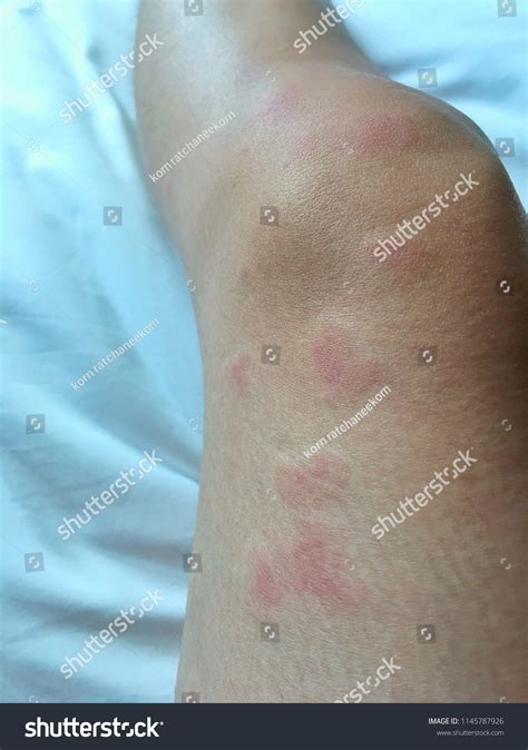 202 Red Lupus Patient Images, Stock Photos & Vectors | Shutterstock