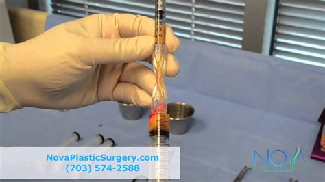 Kuvatulokset haulle breast reconstruction with fat transfer