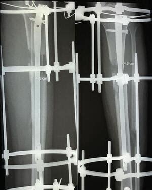 What Is Limb Lengthening Height Increase Info - Health, Beauty ...