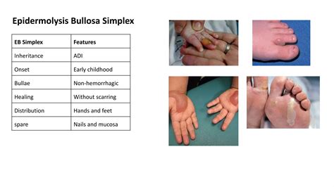 Epidermolysis bullosa | PPTX